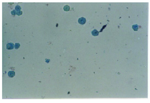 Figure 4. The effect of co-administration of magnetite nanoparticles in edible paraffin oil and doxorubicin (see sample 2 in Table 1) against MDA-MD-468 cells in the presence of an alternate magnetic field for 30 min. All cells were dead (stained with trypan blue)