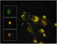 Figure 5. Apoptotic forms of OVCAR3 cell line observed by fluorescence microscope. OVCAR3 cell line was stained with annexinV-FITC/PI. Arrows show the plasma membrane asymmetry in early apoptotic cells. Boxes show different stage of apoptosis such as early and late / already dead cells