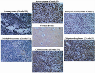 Figure 2. TSGA10 is expressed in human normal brain and over-expressed in human brain tumors
By immunohistochemistry and utilizing polyclonal antibody (raised in rabbit) and Cybrdi tissue microarray, TSGA10 expression is shown in normal brain, and in different brain tumors in human. TSGA10 expression shows a significant increase in human brain tumors compared to normal brain. �Glioblastoma� followed by �pilocytic astrocytoma� and �astrocytoma (grade II)� show the highest expression of TSGA10 protein and �medulloblastoma� the lowest among the brain tumors. (Zeiss microscope, x40)