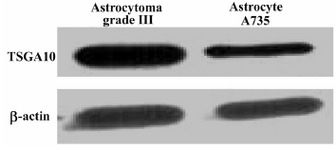 Figure 4. TSGA10 protein expression in astrocytes
Western blots for TSGA10 expression in astrocytes derived from a grade III astrocytoma (left panel) and an astrocyte cell line (735), in which its expression  normalized to β-actin. TSGA10 protein levels in grade III astrocytoma is significantly increased compared to the astrocyte cell line (735).