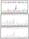 <p>Figure 2. Sanger sequencing chromatograms showing the nucleotide deletion found in the patient in homozygous (Top panel; the arrow represents deletion of G between G and T) and in her parents in heterozygous states. Middle and bottom panels show her father and her mother sequences, respectively.</p>

