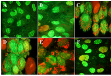 <p>Figure 3. The effects of different doses of <em>Anethum graveolens L.</em> (dill) seed aqueous extract on apoptotic activity of cultured granulosa cells, acridine orange/ethidium bromide staining, &acute;100 magnification. A) Control culture B) 10 <em>&mu;g/ml</em>, C) 50 <em>&mu;g/ml</em> D) 100 <em>&mu;g/ml</em>, E) 500 <em>&mu;g/ml</em> and F) 1000 <em>&mu;g/ml</em> of <em>Anethum graveolens L.</em> extract treated culture. Please note to viable cells with green nucleus, early apoptotic stage cells with light green or yellowish nuclei, chromatin condensation and the formation of blebs on the cell surface and apoptotic nuclei with red nuclei.</p>