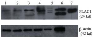<p>Figure 4. Representative data on PLAC1 protein expression pattern in AML and ALL patients. PLAC1 and &beta;-actin proteins bands laid on 21 and 42 kDa in SDS-PAGE 10%.</p>
<p>Lanes 1: AML21-PB, 2: AML23-PB, 3: ALL25-PB, 4: ALL27-PB, 5: ALL19-BM, 6: human placenta, 7: PLAC1 recombinant protein.</p>
